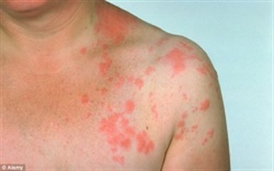 ross-river-rash