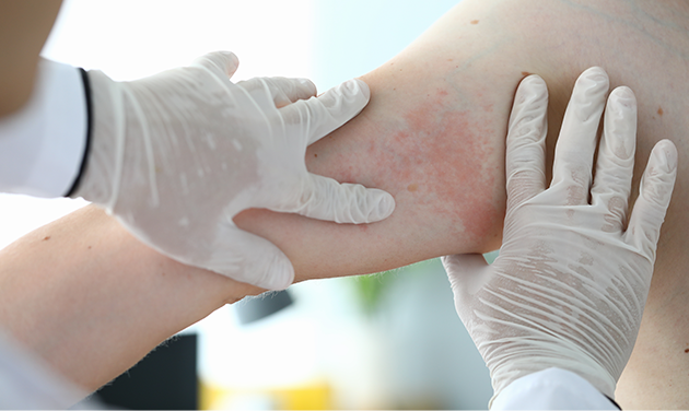Zika Virus