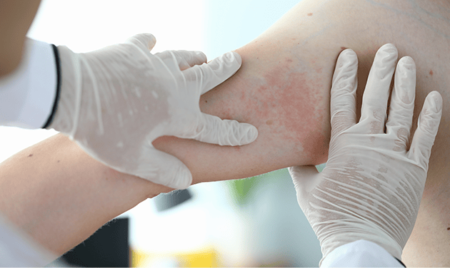 Zika Virus