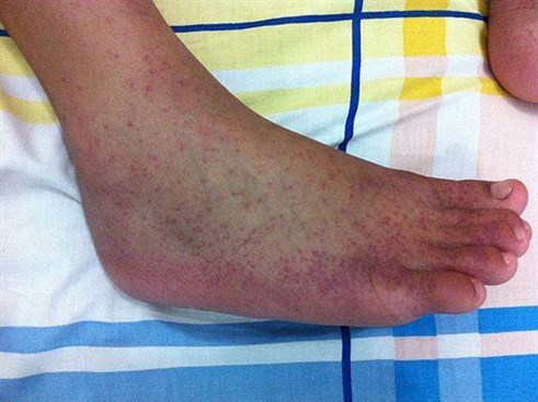 Chikungunya on the right foot