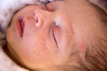 small-dengue-fever